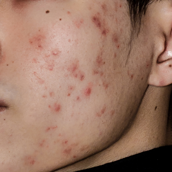 detergenti viso acne