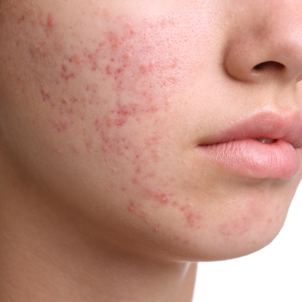 acne come curarla naturalmente (1)